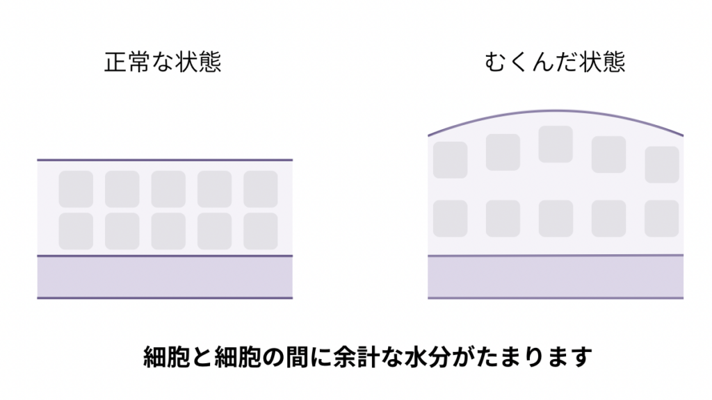 正常な状態とむくんだ状態